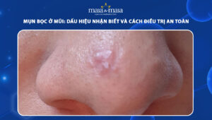 mụn bọc ở mũi