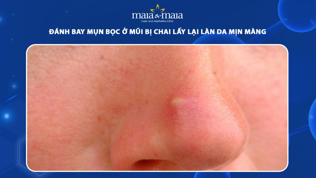 Đánh bay mụn bọc ở mũi bị chai lấy lại làn da mịn màng 1 mụn bọc ở mũi bị chai