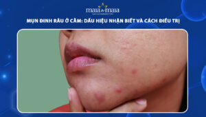 mụn đinh râu ở cằm