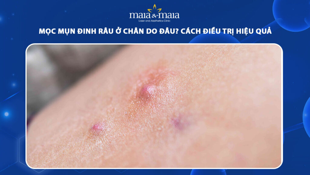 mụn đinh râu ở chân