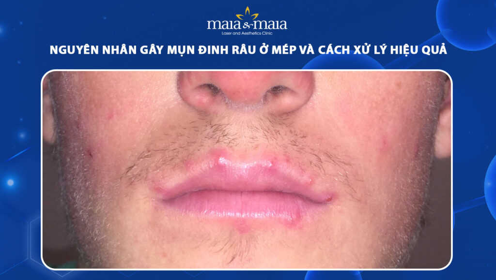 mụn đinh râu ở mép