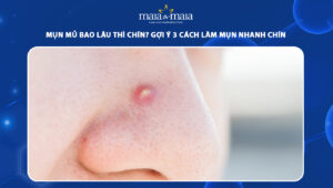 mụn mủ bao lâu thì chín