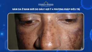 nám da ở nam giới