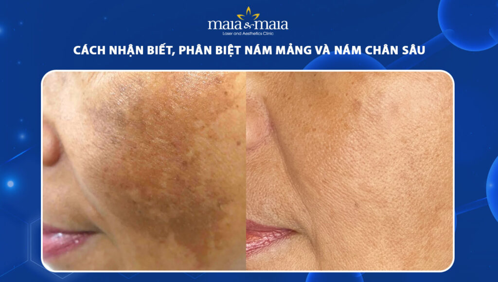 nám mảng và nám chân sâu