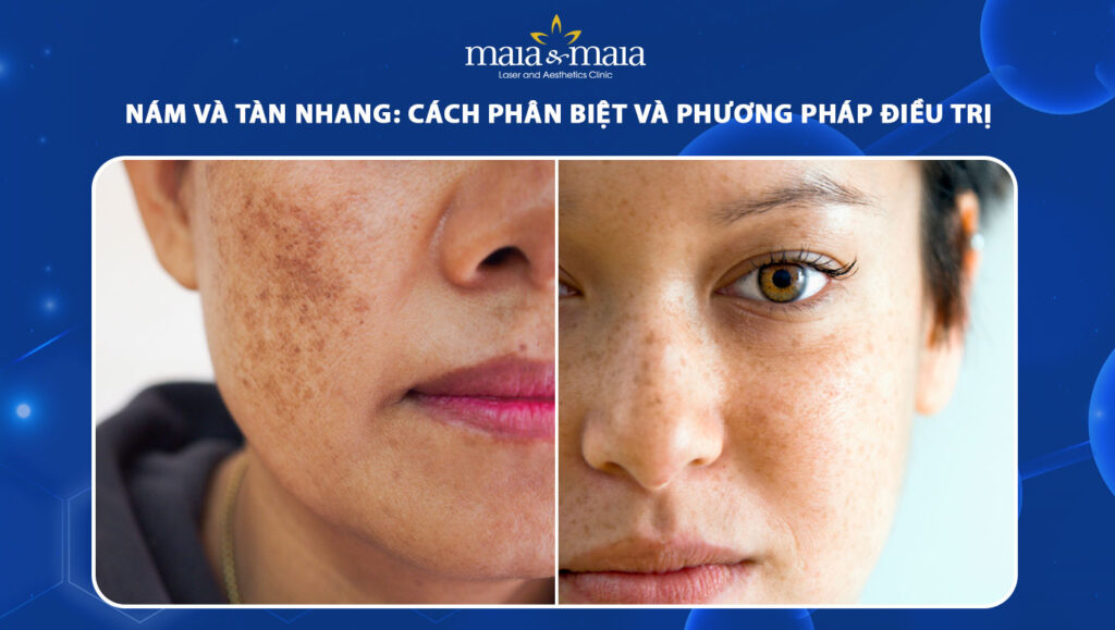 Nám và tàn nhang: Cách phân biệt, phương pháp điều trị 1 nám và tàn nhang
