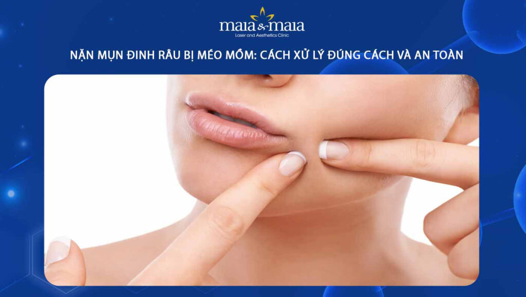 nặn mụn đinh râu bị méo mồm