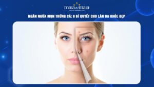 ngăn ngừa mụn trứng cá