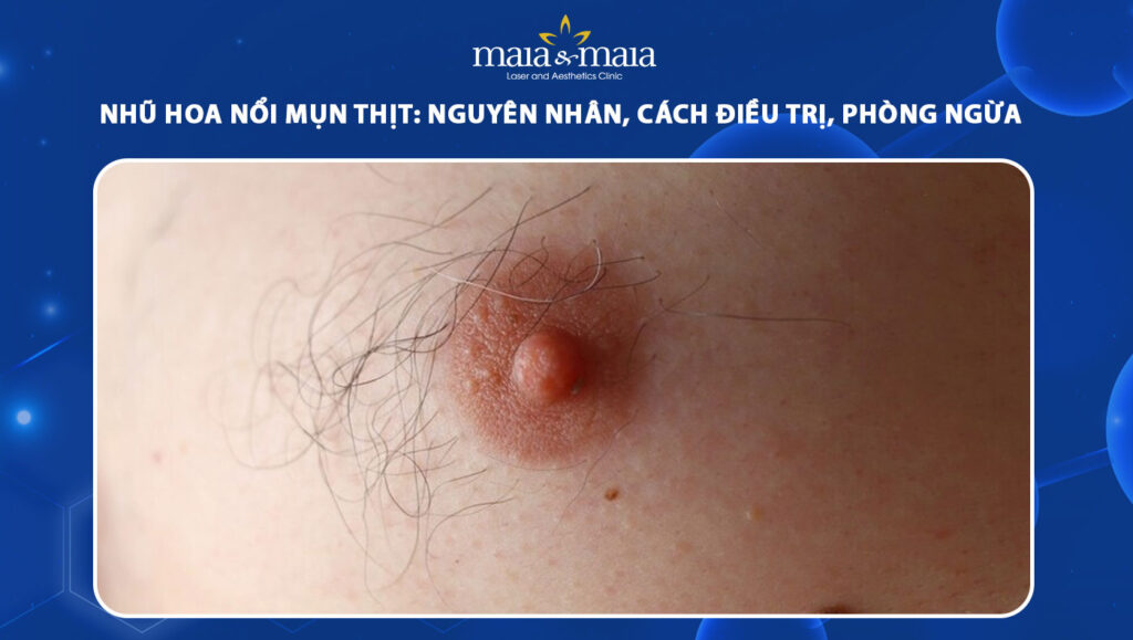 Nhũ hoa nổi mụn thịt