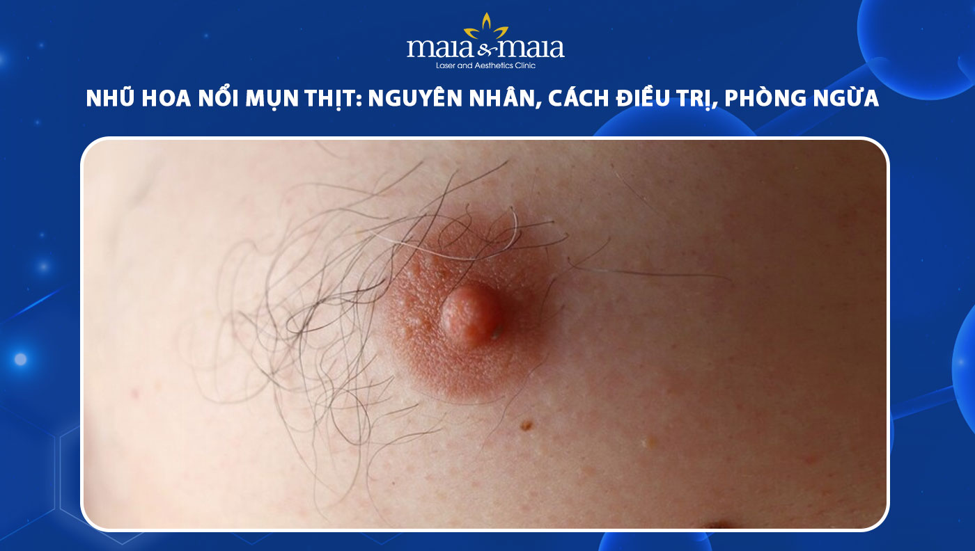 Nốt Ruồi Ở Núm Vú: Giải Mã Ý Nghĩa Tình Duyên, Sự Nghiệp Và Sức Khỏe