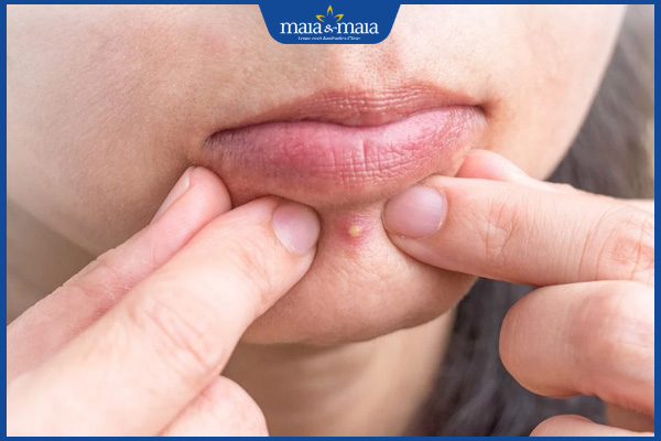 Mụn đinh râu ở cằm: Dấu hiệu nhận biết và cách điều trị an toàn 2 nốt mụn đinh râu ở cằm