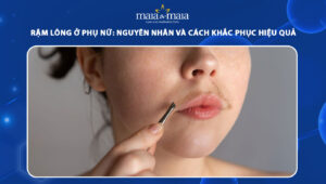 rậm lông ở phụ nữ