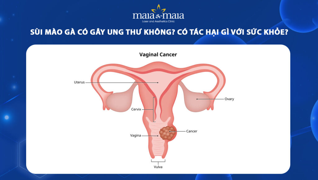 Sùi mào gà có gây ung thư không? Có tác hại gì với sức khỏe? 1 Sùi mào gà có gây ung thư không