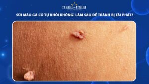 sùi mào gà có tự khỏi không