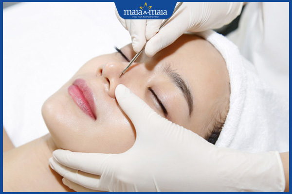 Hướng dẫn cách nặn mụn bọc bị chai cứng an toàn tại nhà 3 thực hiện nặn mụn bọc