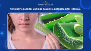 trị mụn bọc bằng nha đam