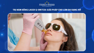 trị nám bằng laser Q-Switch