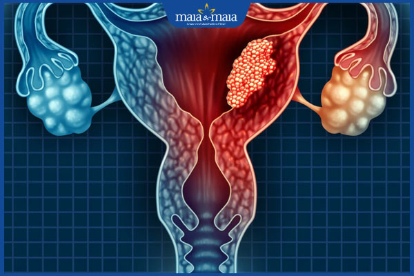 u ở buồng trứng