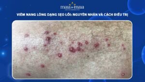 viêm nang lông dạng sẹo lồi