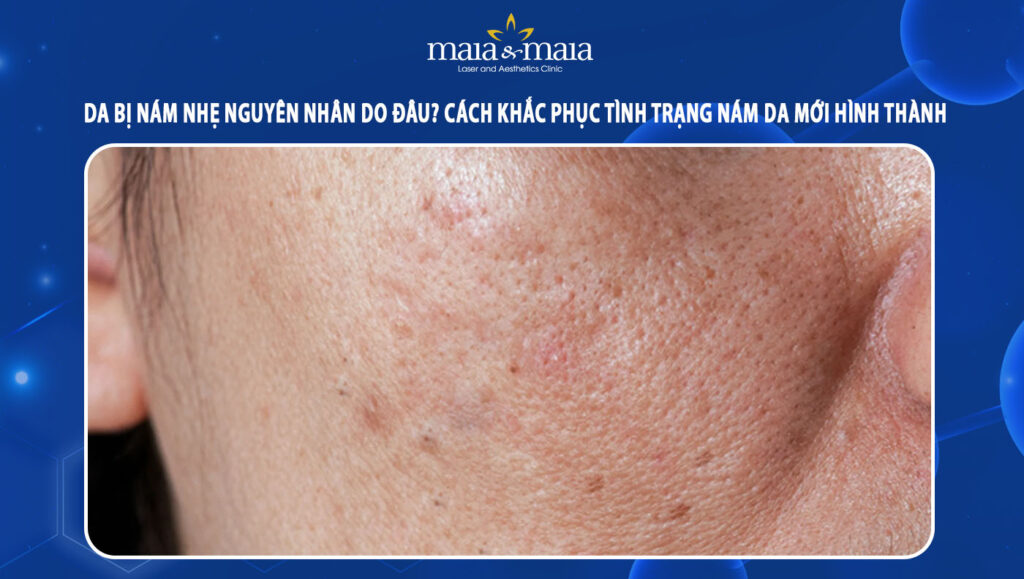 Da bị nám nhẹ