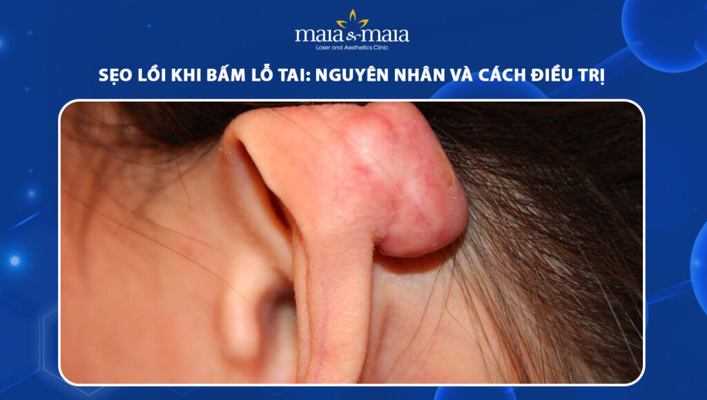 Sẹo lồi khi bấm lỗ tai: Nguyên nhân và cách điều trị 1 Sẹo lồi khi bấm lỗ tai