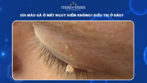 Sùi mào gà ở mắt