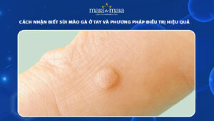 Sùi mào gà ở tay