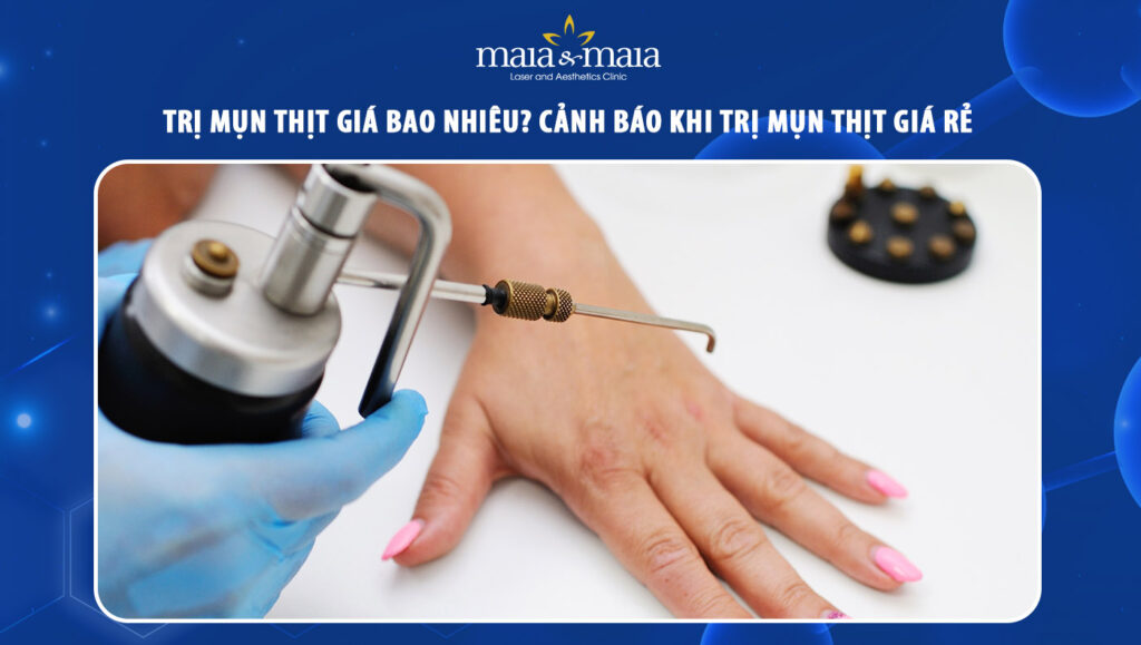 Trị hạt cơm bằng nitơ lỏng