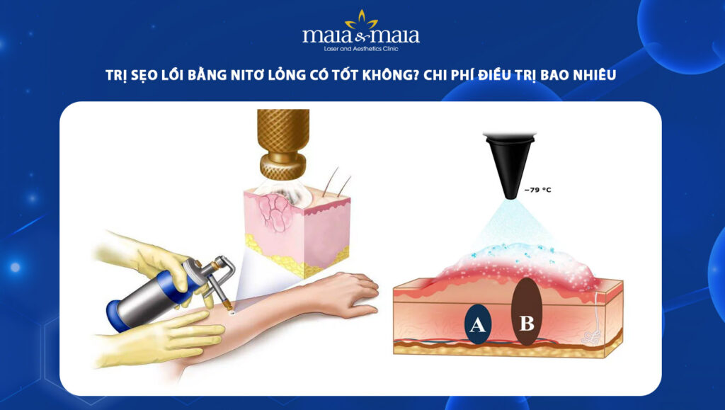 Trị sẹo lồi bằng nitơ lỏng