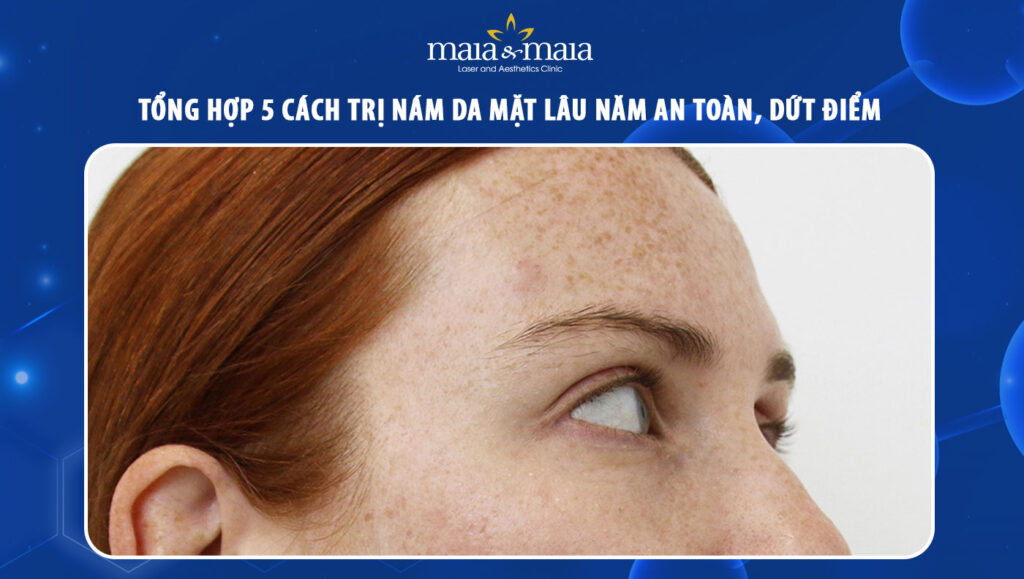 cách trị nám da mặt lâu năm