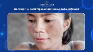 cách trị nám sau sinh