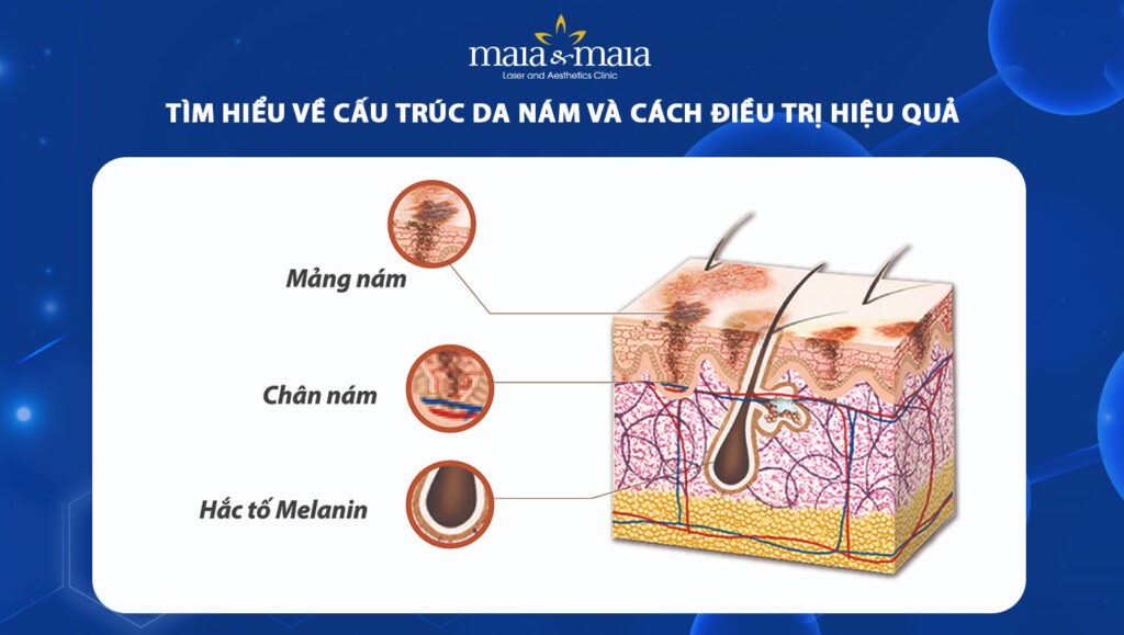 cấu trúc da nám