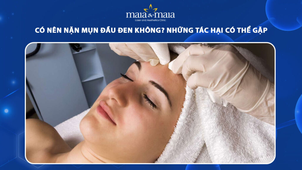 có nên nặn mụn đầu đen không