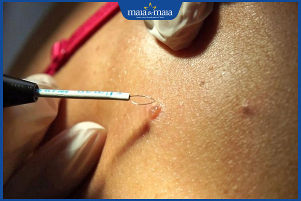 Nam giới bị sùi mào gà có con được không? Cần chú ý gì? 3 đốt điện trị sùi mào gà