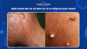 Giang mai và sùi mào gà