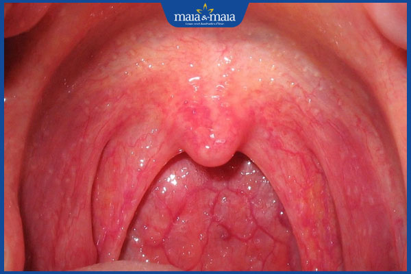 Sùi mào gà ở họng có nguy hiểm không? Điều trị như thế nào? 4 họng nổi nốt sùi