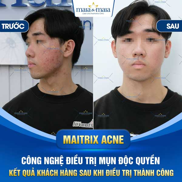 khách chữa mụn đầu đen thành công