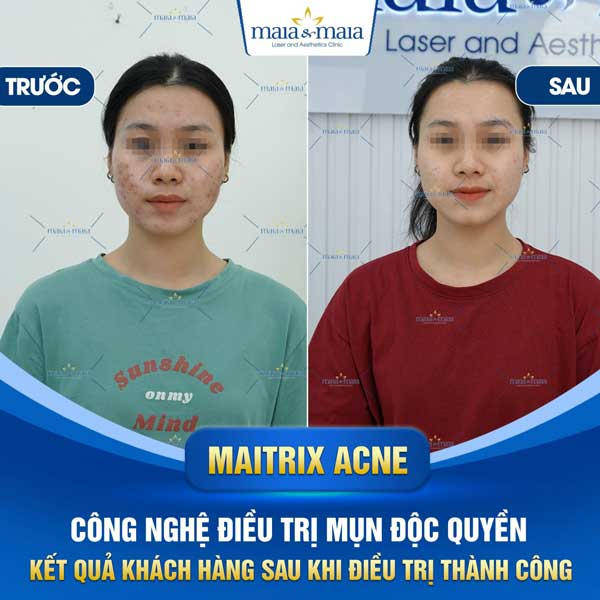 khách chữa mụn đầu đen