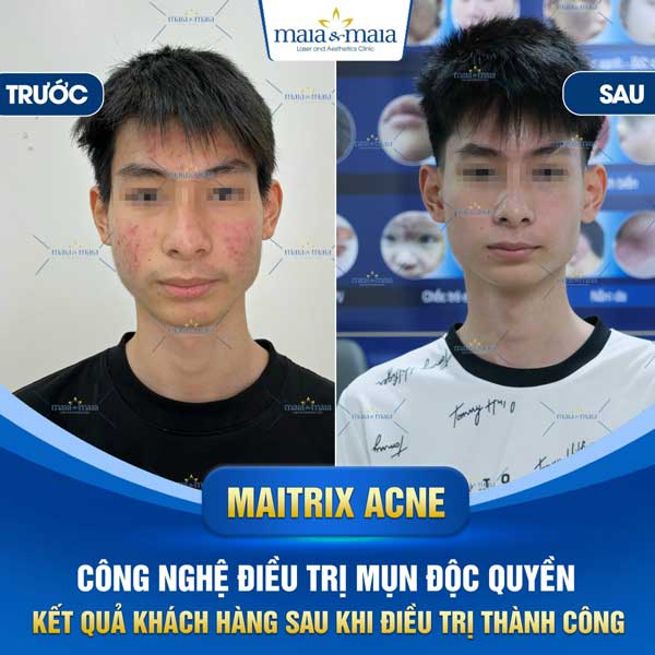 khách trị mụn đầu đen tại maia