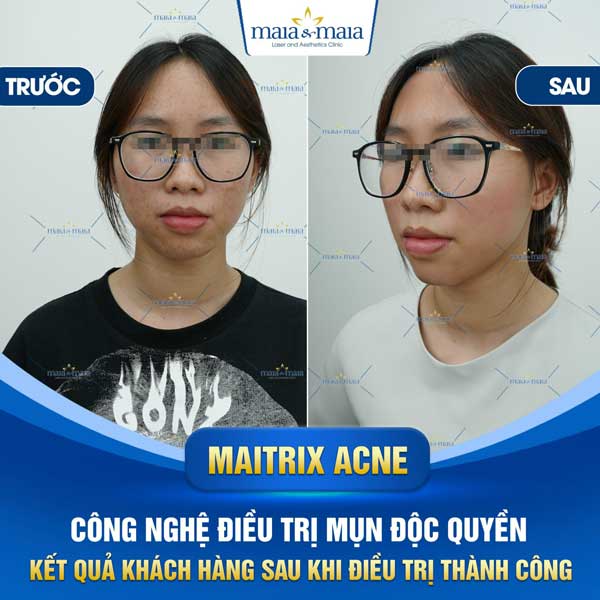 khách trị mụn đầu đen thành công