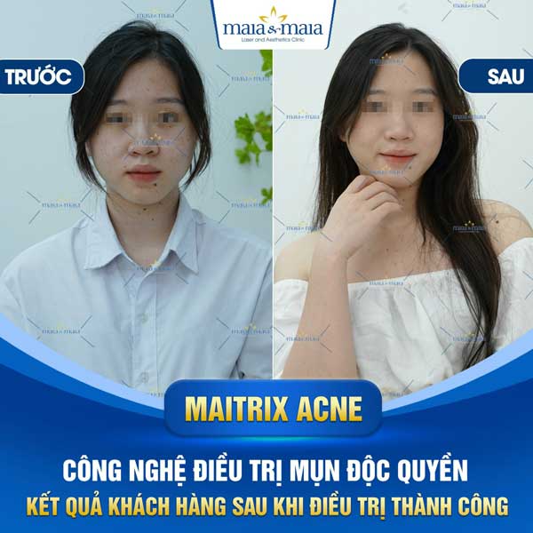 khách trị mụn đầu đen