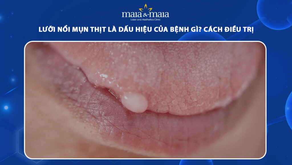 Lưỡi nổi mụn thịt là dấu hiệu của bệnh gì? Cách điều trị 1 lưỡi nổi mụn thịt