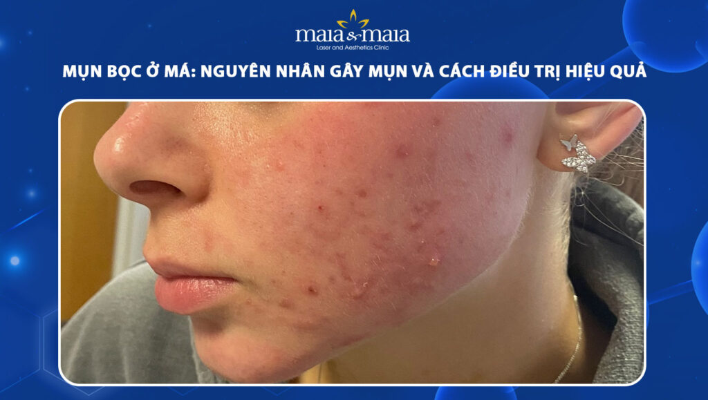 Mụn bọc ở má: Nguyên nhân gây mụn và cách điều trị hiệu quả 1 mụn bọc ở má