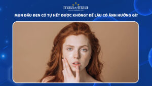 mụn đầu đen có tự hết được không