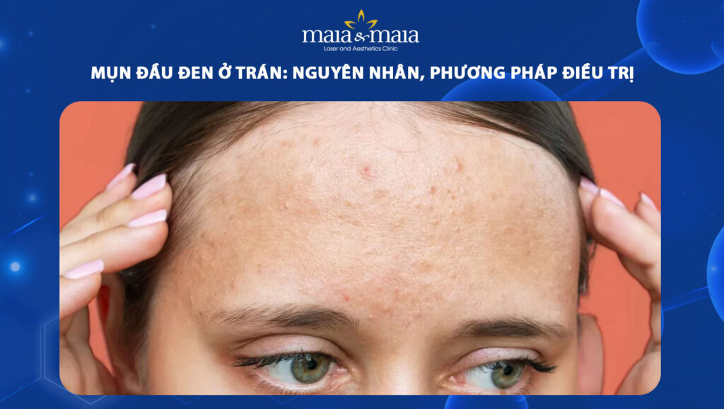 mụn đầu đen ở trán