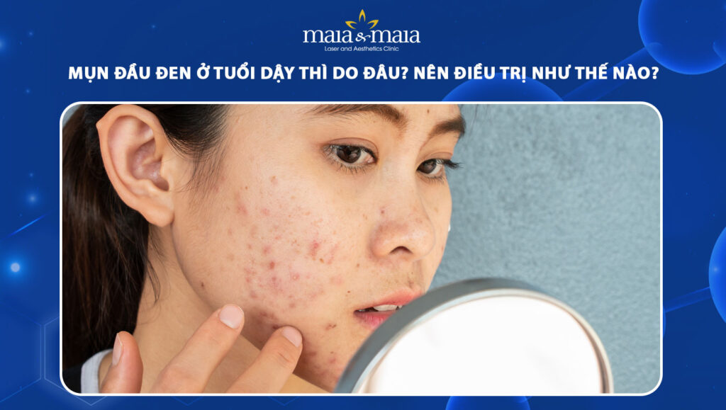 Mụn đầu đen ở tuổi dậy thì do đâu? Nên điều trị như thế nào? 1 mụn đầu đen ở tuổi dậy thì