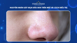 mụn đầu đen trên mặt