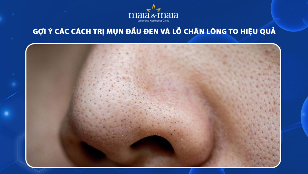 mụn đầu đen và lỗ chân lông to