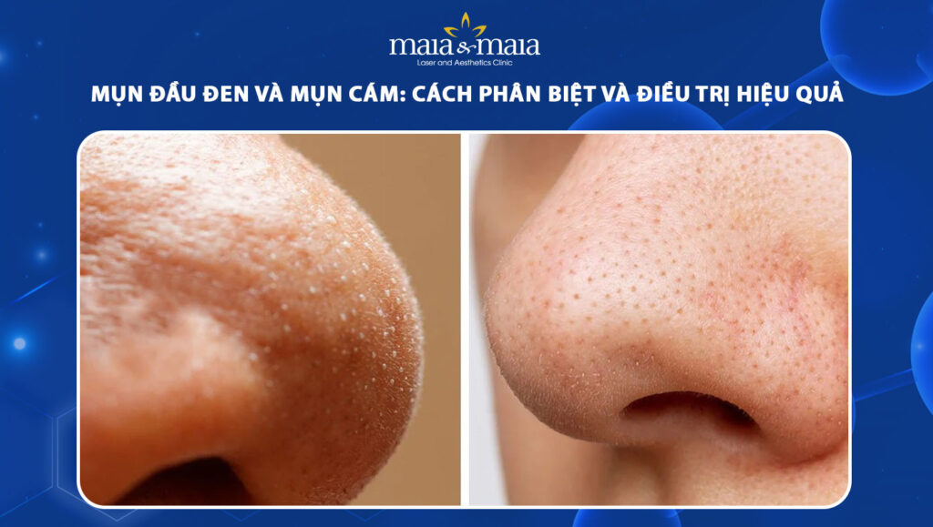 mụn đầu đen và mụn cám