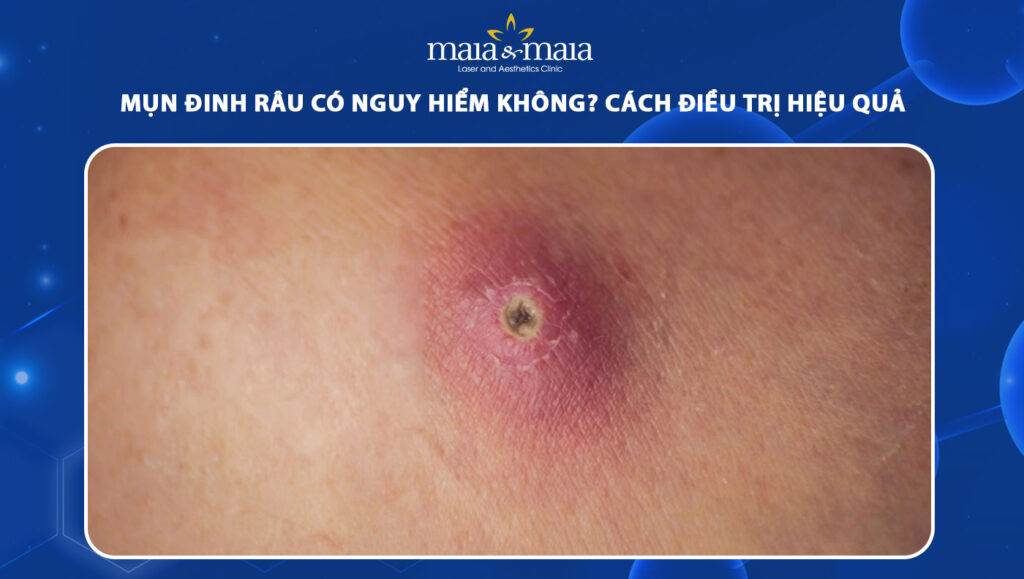 mụn đinh râu có nguy hiểm không