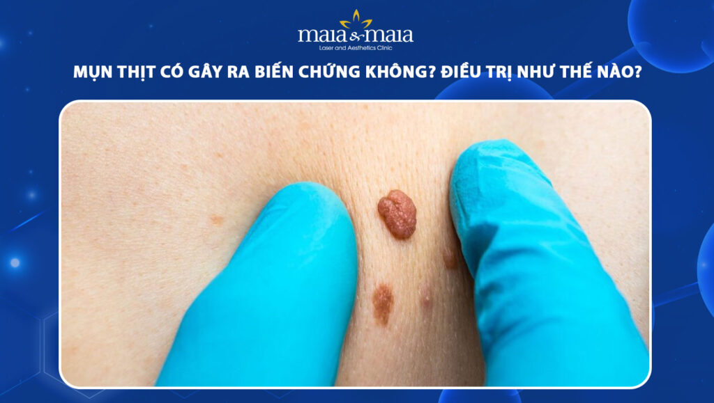 mụn thịt có gây ra biến chứng không